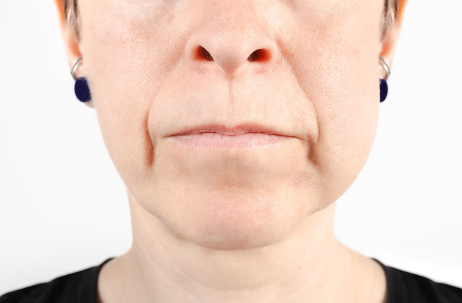 A person has a swollen face from tooth extraction, and will need to eat soft food until the swelling goes down.